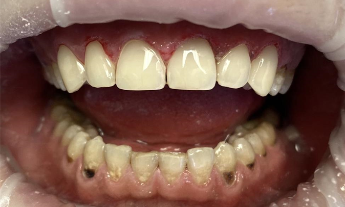 Эстетическая реставрация фронтальной группы зубов